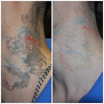 Modus Studio Photo / Laser Tattoo Removal