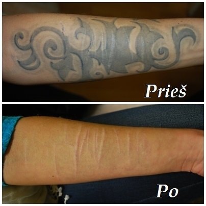 Modus Studio Photo / Laser Tattoo Removal