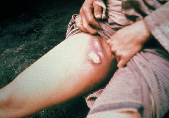 Wikipedia.org photo / Bubbles in the groin of a person with plague