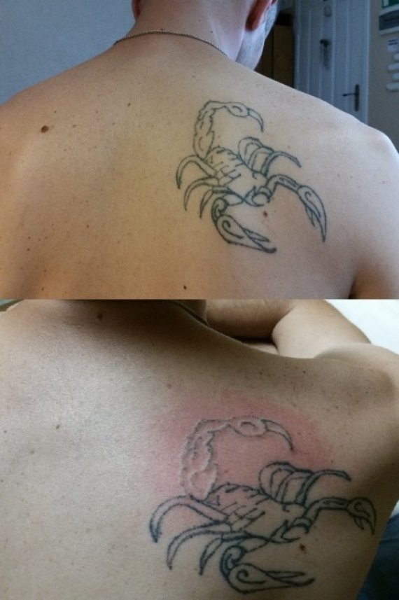 Modus Studio Photo / Laser Tattoo Removal