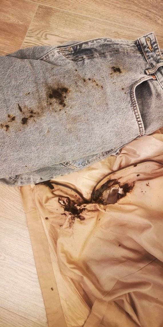 Photo from personal album / Ilona Pakeltė's clothes caught fire with phosphor pebble